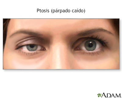 Descenso del párpado por ptosis