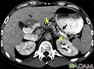 Tomografía computarizada - pancreatitis crónica