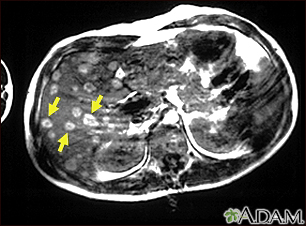 IRM del melanoma del hígado