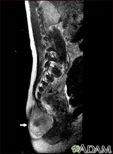 Teratoma - IRM