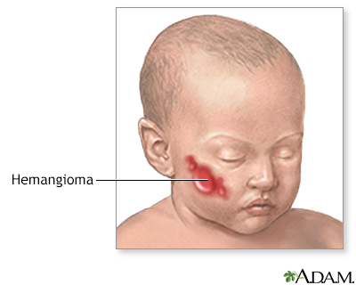 Extirpación quirúrgica de un hemangioma - serie