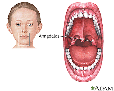 Amigdalectomía - Serie