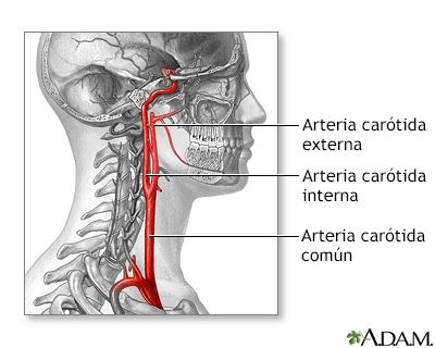 Cirugía de la arteria carótida - serie