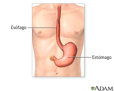 Colocación de un tubo de gastrostomía - serie