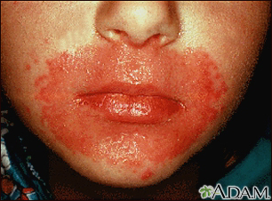 Candidiasis, cutánea - alrededor de la boca