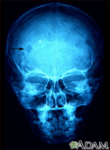 Granuloma eosinofílico - Radiografía del cráneo