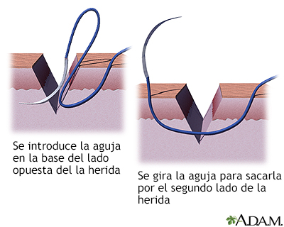 Cómo cerrar una herida por sutura (tercera parte)