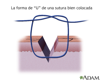 Cómo cerrar una herida por sutura (cuarta parte)