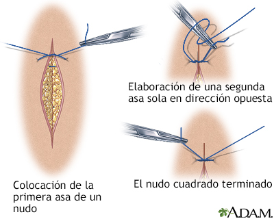 Cómo cerrar una herida por sutura (sexta parte)
