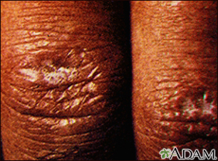 Pápula de Gottron en dermatomiositis