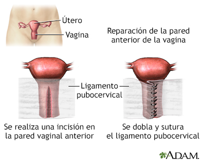 Reparación de la pared vaginal anterior