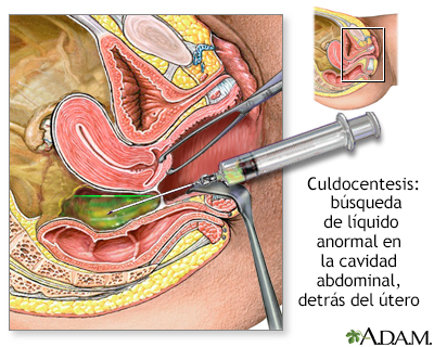 Culdocentesis