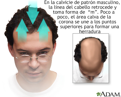 Calvicie de patrón masculino