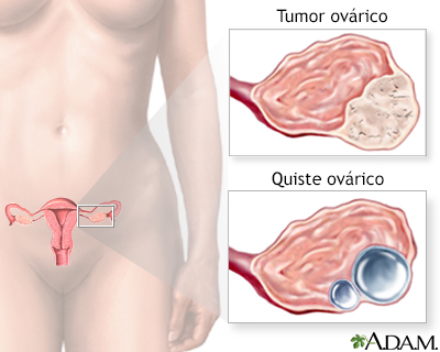 Preocupación por masas ováricas