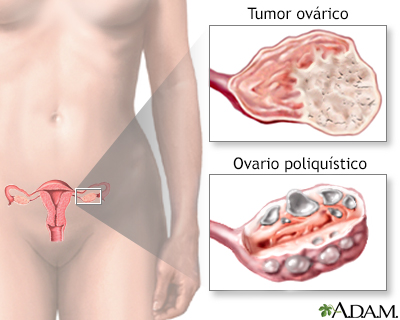 Sobreproducción ovárica