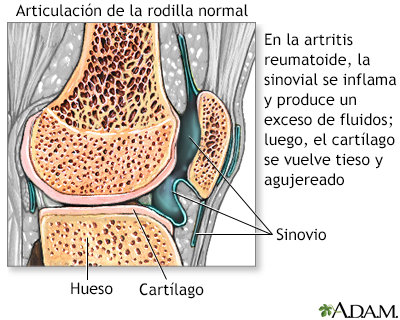 Artritis reumatoide