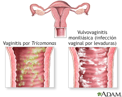 Causas de prurito vaginal