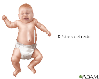 Diástasis del recto