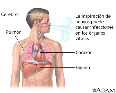 Coccidioidomicosis diseminada