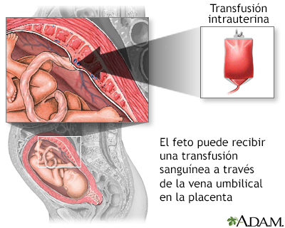 Transfusión intrauterina