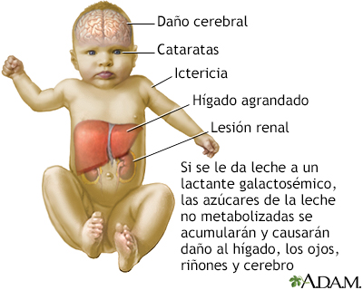 Galactosemia