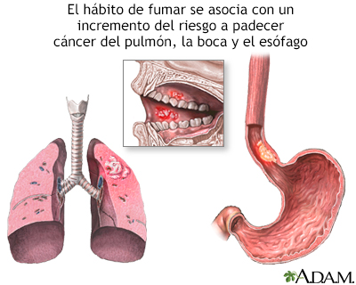 Tabaco y cáncer