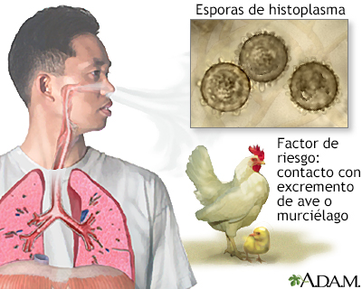 Histoplasmosis aguda