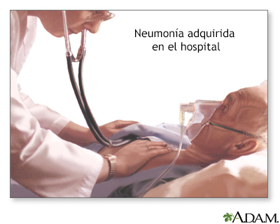 Neumonía adquirida en el hospital