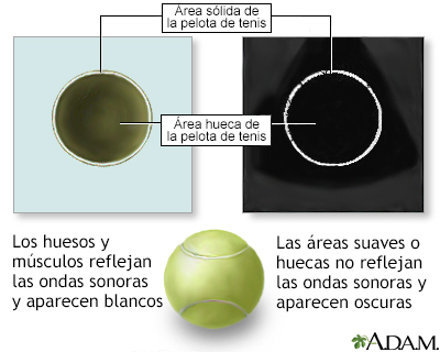 Comparación sobre el ultrasonido