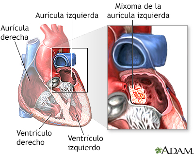 Mixoma de la aurícula izquierda