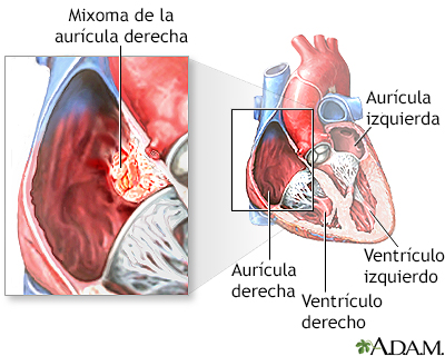 Mixoma de la aurícula derecha