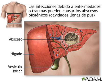 Absceso piogénico