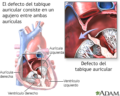 Defecto del tabique auricular