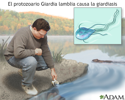 Giardiasis