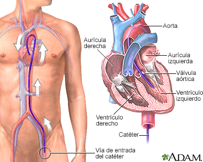 Cateterización del corazón izquierdo