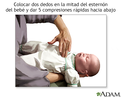 Maniobra de Heimlich en lactantes