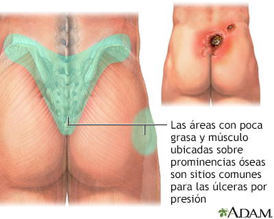 Áreas donde se presentan las úlceras de presión