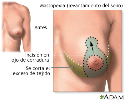 Elevación de mamas (mastopexia) - serie - Incisión