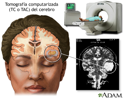 TC del cerebro