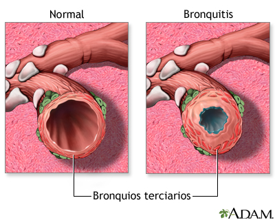 Bronquitis y condición normal de los bronquios terciarios