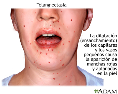 Telangiectasia