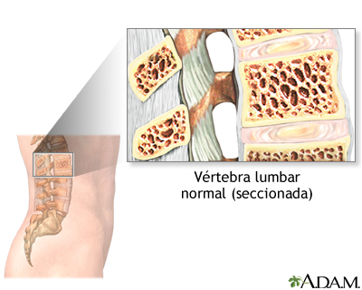 Vertebroplastia - serie