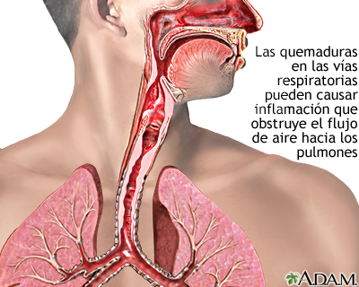 Quemadura de las vías respiratorias