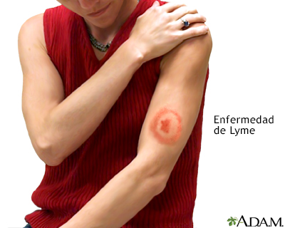 Enfermedad de Lyme