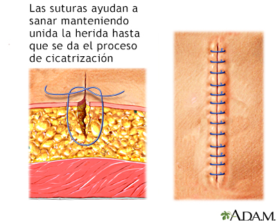 Suturas