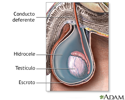 Hidrocele