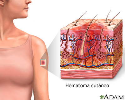 Hematoma de la piel