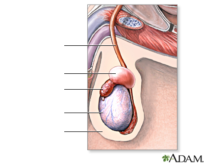 Espermatocele