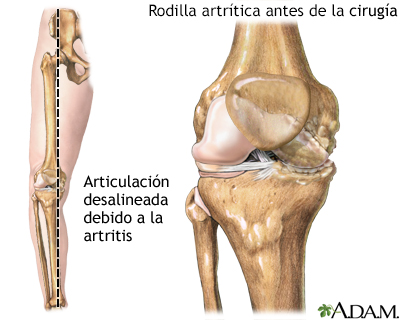 Rodilla desalineada debido a la artritis