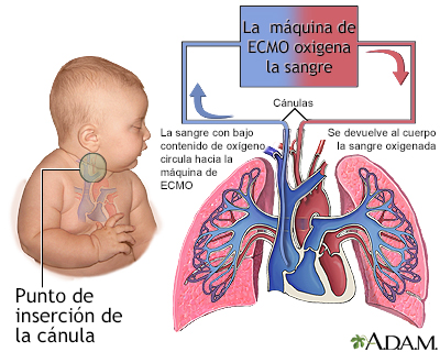 ECMO